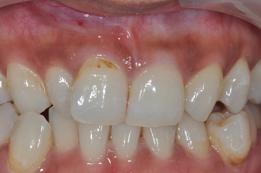 Before