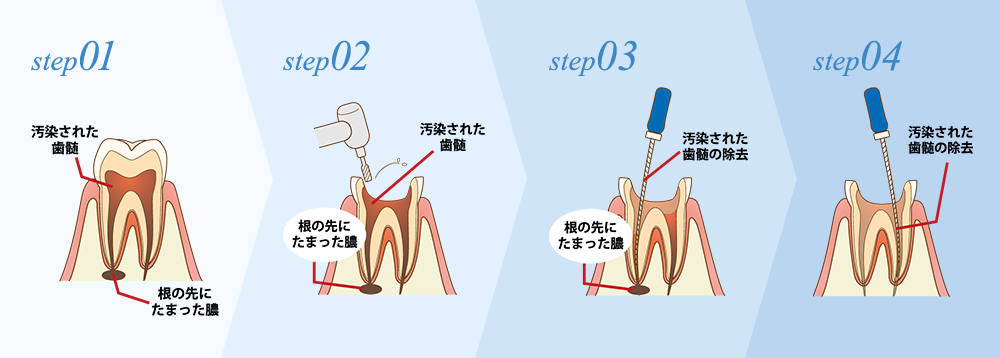 根管治療とは